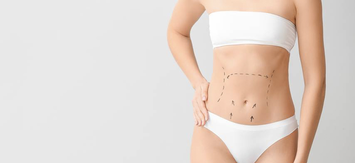 Abdominoplasty